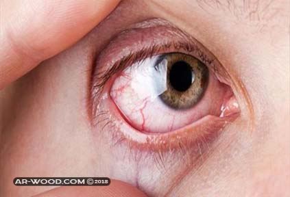 علاج الاكياس الدهنية تحت العين بالاعشاب