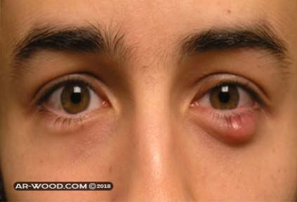 علاج الكيس الدهني في العين بالاعشاب