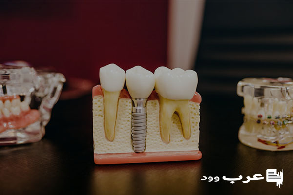 تفسير حلم سقوط الأسنان التركيب