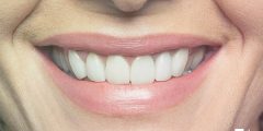 هل تلبيس الاسنان يحتاج بنج؟